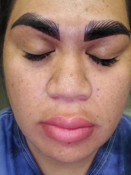 Sobrancelha Pigmentacao Exagerada